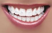 Low Cost Ceramic Braces in Madurai