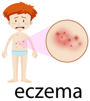Atopic Eczema Causes And Treatment