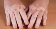 What is Vitiligo? – Understanding the condition and its effects