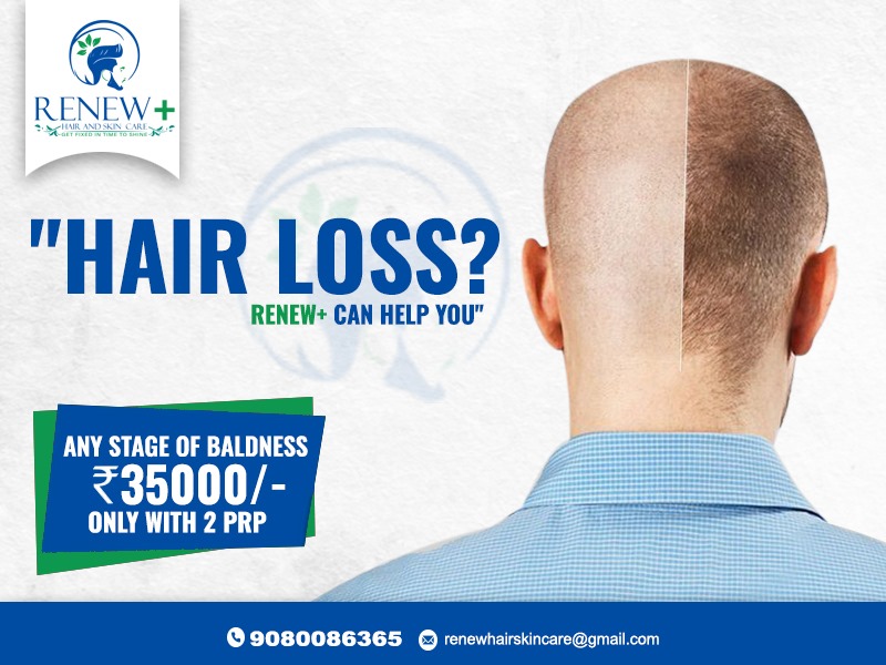 Best Hair Fall Treatment in Madurai - Renew Plus Hair and Skin Care - Tamil  Nadu - Health services, beauty services, Tamil Nadu - 3045653