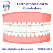 Teeth Braces Cost in Coimbatore | Affordable Braces Coimbatore