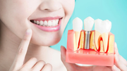 Same Day Dental Implants in Chennai – Akeela Dental