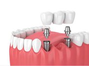 Transform Your Smile with a Complete Teeth Set at Akeela Dental