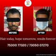 Best hair transplant hospital in chennai