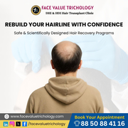 Hairline Transplant in Chennai | Best Hair Restoration Clinic